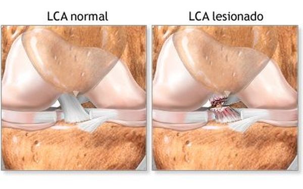 Ligamento cruzado anterior. ligamentoplastia, rehabilitación y readaptación