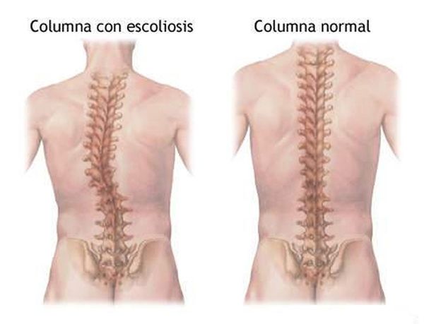 Escoliosis del adolescente y su tratamiento mediante fisioterapia, osteopatía y Pilates