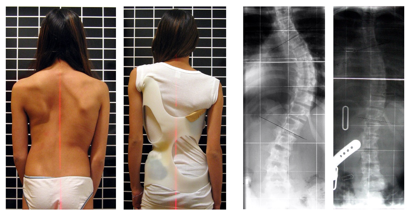 Escoliosis del adolescente y su tratamiento mediante fisioterapia, osteopatía y Pilates