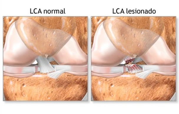 Ligamento cruzado anterior. ligamentoplastia, rehabilitación y readaptación