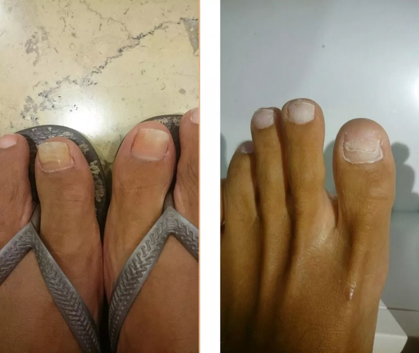 SmileFeet, el nuevo servicio de Podoactiva para la reconstrucción de uñas con acabado estético